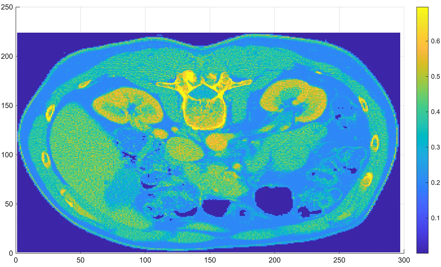 The proton Computed Tomography (pCT) of an abdominal slice. The slice consist of voxels 1mm cube known as voxels. The color bar reflects the Relative Stopping Power (RSP) of each voxel as would be “seen” by 200MeV proton. The image was obtained using simulated 330 MeV protons, as this is the highest commercial therapeutic proton energy available. Note that the NIST Energy vs. RSP table allows us to estimate the RSP of a voxel at any therapeutic proton energy, once we know the RSP at a given proton energy.